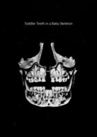 Toddler Teeth in a Baby Skeleton